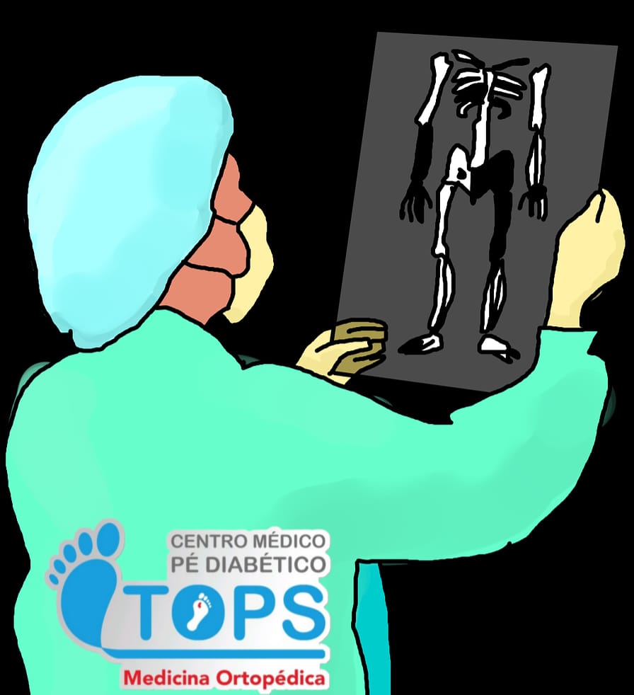 OSTEOMIELITE NO PÉ DIABÉTICO: URGÊNCIA OU EMERGÊNCIA?