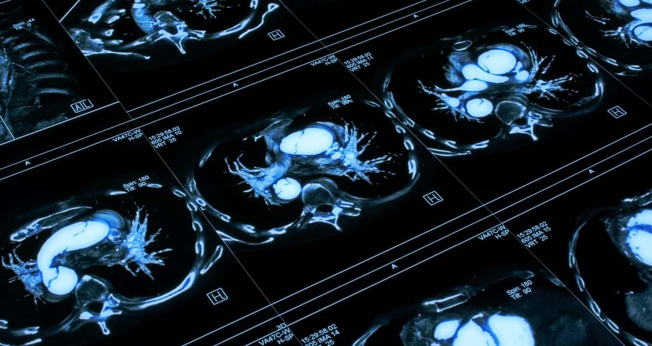 Dor de cabeça repentina pode ser sintoma de aneurisma cerebral