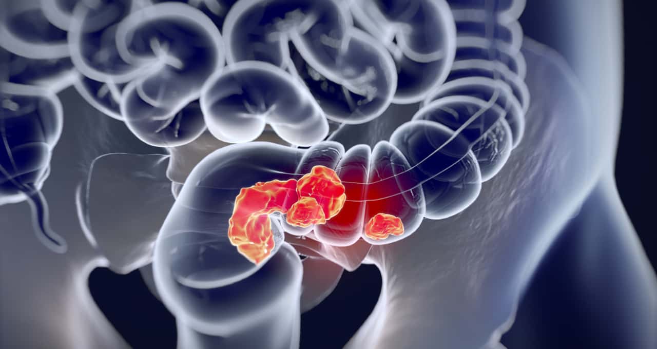 Estudo revela vitamina aliada na prevenção do câncer de intestino