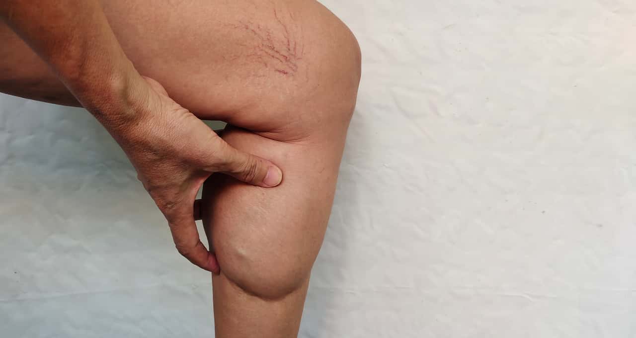 Lipedema afeta milhões de brasileiras e ainda é confundido com obesidade