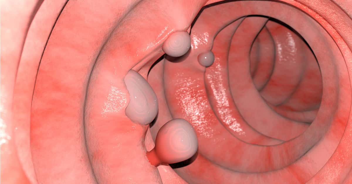 Atenção para sinal sutil de câncer de intestino