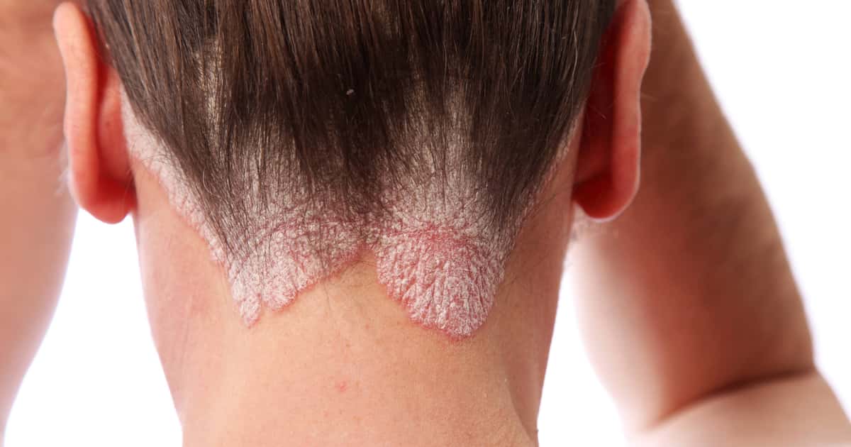 Excesso de ferro no corpo pode estar piorando a inflamação da Psoríase