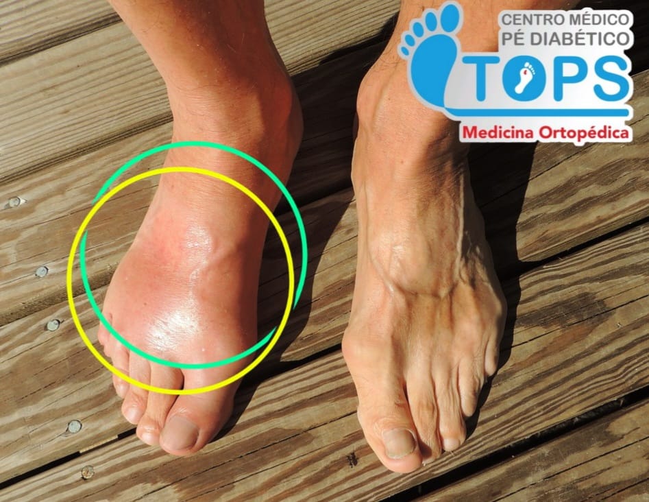 Osteoartropatia Neuropática de Charcot.
