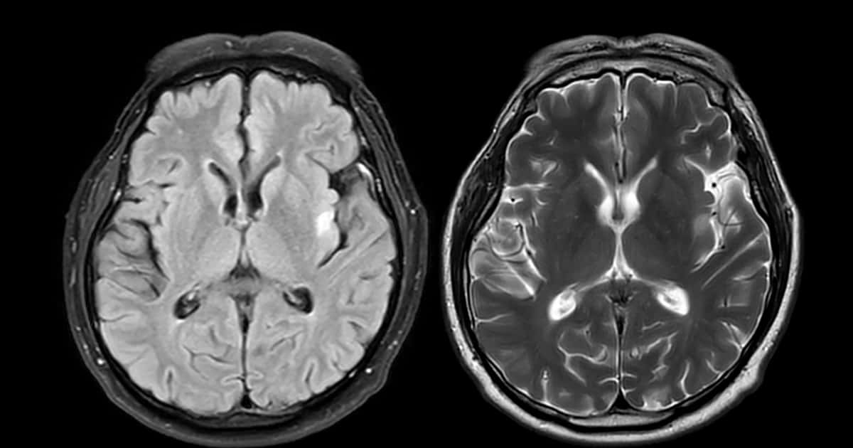 Combinação de remédios reverte sintomas de Alzheimer em estudo promissor