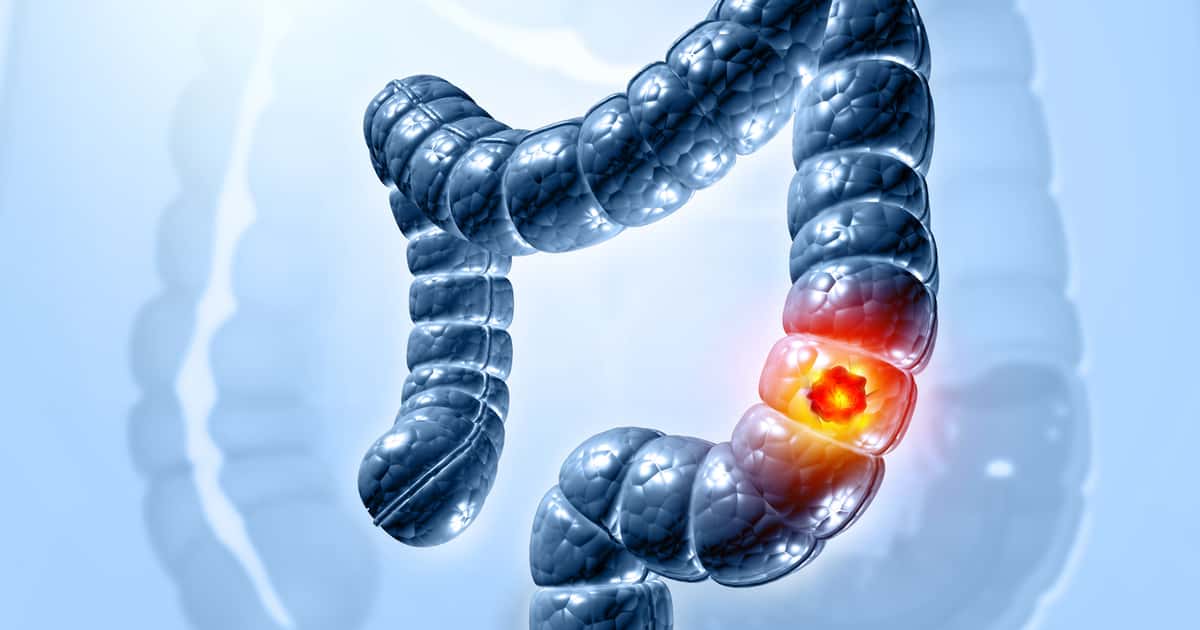 Um sintoma quase invisível pode ser o primeiro alerta do câncer de intestino