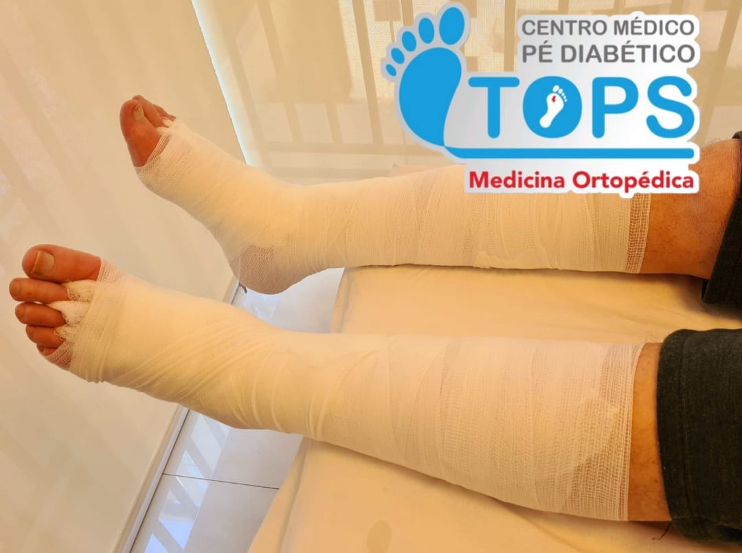 Medicina de Precisão na Cicatrização deFeridas Complexas e Salvamento Funcional de Membros.